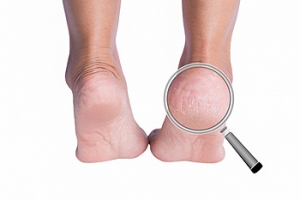 Cracked Heels and Diabetics