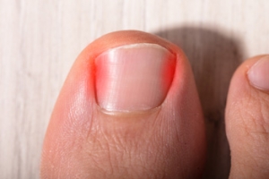 What Causes Ingrown Toenails?
