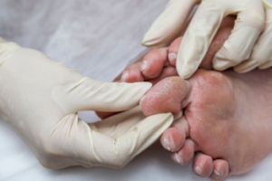 Debridement of Diabetic Foot Wounds