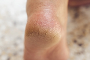 Cracked Heels and Vitamin Deficiencies