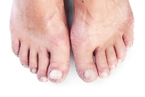 Psoriatic Arthritis and the Feet