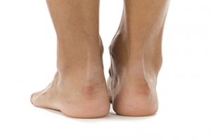 Explaining Haglund’s Deformity