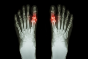 Exploring the Link Between Diet and Gout